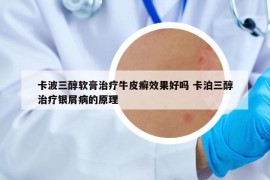 卡波三醇软膏治疗牛皮癣效果好吗 卡泊三醇治疗银屑病的原理