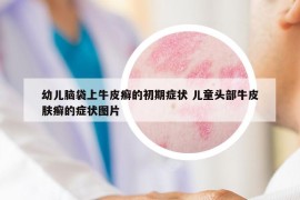幼儿脑袋上牛皮癣的初期症状 儿童头部牛皮肤癣的症状图片