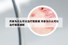 丹参为什么可以治疗银屑病 丹参为什么可以治疗银屑病呢