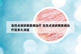 急性点滴状银屑病治疗 急性点滴状银屑病治疗后多久消退
