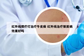 红外线理疗灯治疗牛皮癣 红外线治疗银屑病效果好吗