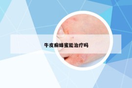 牛皮癣蜂蜜能治疗吗