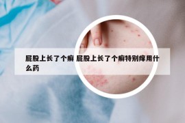 屁股上长了个癣 屁股上长了个癣特别痒用什么药
