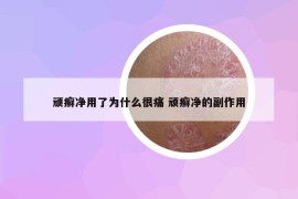 顽癣净用了为什么很痛 顽癣净的副作用