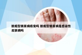 脓疱型银屑病癌变吗 脓疱型银屑病是感染性皮肤病吗