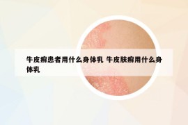 牛皮癣患者用什么身体乳 牛皮肤癣用什么身体乳