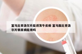 富马比索洛尔片能诱发牛皮癣 富马酸比索洛尔片银屑病能用吗