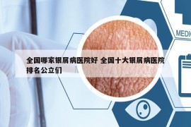 全国哪家银屑病医院好 全国十大银屑病医院排名公立们