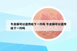 牛皮癣可以遗传给下一代吗 牛皮癣可以遗传给下一代吗