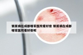 银屑病在成都哪家医院看好些 银屑病在成都哪家医院看好些呢