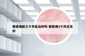 银屑病前三个月能治好吗 银屑病3个月还没好