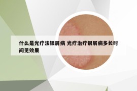 什么是光疗法银屑病 光疗治疗银屑病多长时间见效果