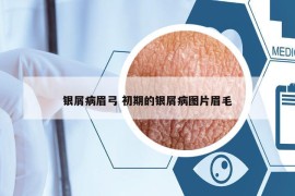 银屑病眉弓 初期的银屑病图片眉毛