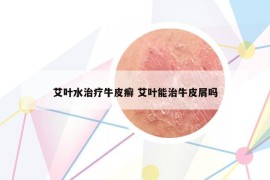 艾叶水治疗牛皮癣 艾叶能治牛皮屑吗