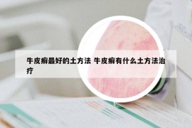 牛皮癣最好的土方法 牛皮癣有什么土方法治疗