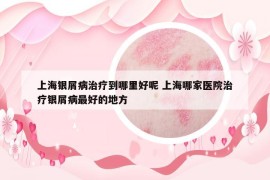 上海银屑病治疗到哪里好呢 上海哪家医院治疗银屑病最好的地方
