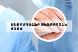 脚趾脓疱病用怎么治疗 脚趾脓疱病用怎么治疗效果好