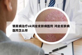 银屑病治疗ok鸿业皮肤病医院 鸿业皮肤病医院怎么样