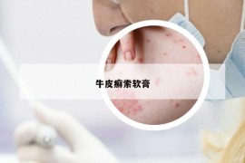 牛皮癣索软膏