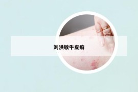 刘洪敏牛皮癣