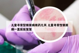 儿童寻常型银屑病用药几天 儿童寻常性银屑病一直反反复复