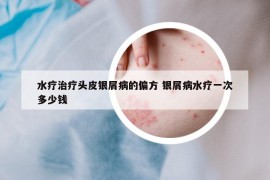 水疗治疗头皮银屑病的偏方 银屑病水疗一次多少钱