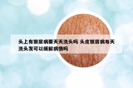 头上有银屑病要天天洗头吗 头皮银屑病每天洗头发可以缓解病情吗