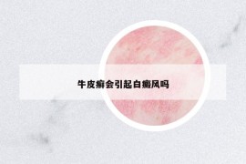 牛皮癣会引起白癜风吗