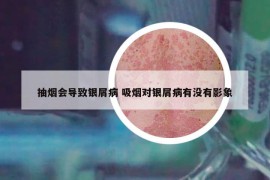 抽烟会导致银屑病 吸烟对银屑病有没有影象