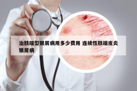治肢端型银屑病用多少费用 连续性肢端皮炎银屑病