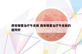 西安哪里治疗牛皮癣 西安哪里治疗牛皮癣的医院好