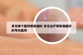 青岛哪个医院银屑病科 青岛治疗银屑病最好的专科医院