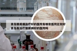 青岛银屑病治疗好的医院有哪些医院比较好 青岛有治疗银屑病好的医院吗