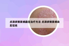 点滴状银屑病最佳治疗方法 点滴状银屑病自愈征兆