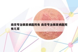 南京专治银屑病医院有 南京专治银屑病医院有几家