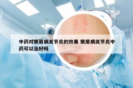 中药对银屑病关节炎的效果 银屑病关节炎中药可以治好吗