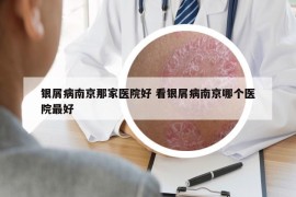 银屑病南京那家医院好 看银屑病南京哪个医院最好