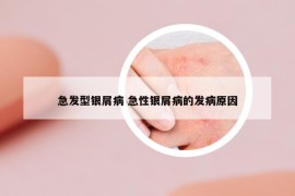 急发型银屑病 急性银屑病的发病原因