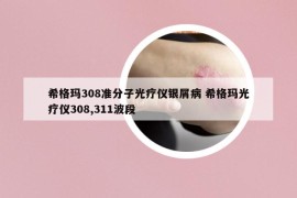 希格玛308准分子光疗仪银屑病 希格玛光疗仪308,311波段