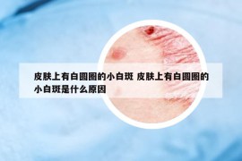 皮肤上有白圆圈的小白斑 皮肤上有白圆圈的小白斑是什么原因