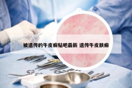 被遗传的牛皮癣贴吧最新 遗传牛皮肤癣