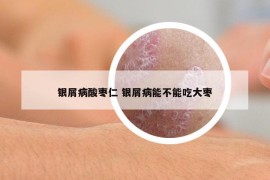 银屑病酸枣仁 银屑病能不能吃大枣