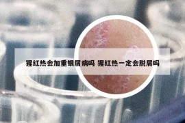 猩红热会加重银屑病吗 猩红热一定会脱屑吗