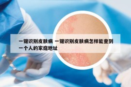 一键识别皮肤病 一键识别皮肤病怎样能查到一个人的家庭地址