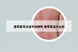 墨旱莲可以治牛皮癣吗 墨旱莲治什么的