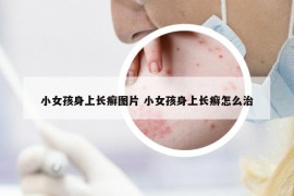 小女孩身上长癣图片 小女孩身上长癣怎么治