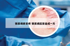 银屑病肩背疼 银屑病后背连成一片