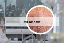 牛皮癣的人在性
