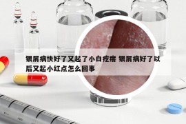 银屑病快好了又起了小白疙瘩 银屑病好了以后又起小红点怎么回事