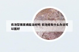 农泡型银屑病能治好吗 农泡疮有什么办法可以医好